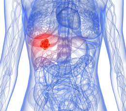 Selecting Therapy in Treatment-Naïve, Advanced HCC